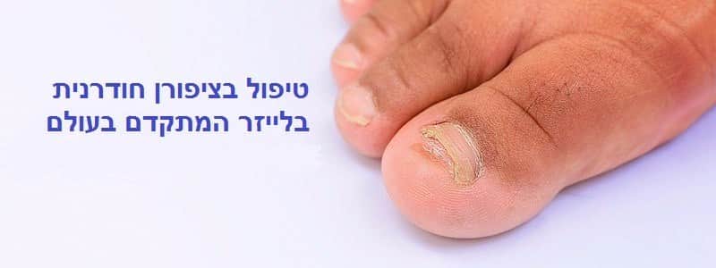 טיפול בציפורן חודרנית בלייזר