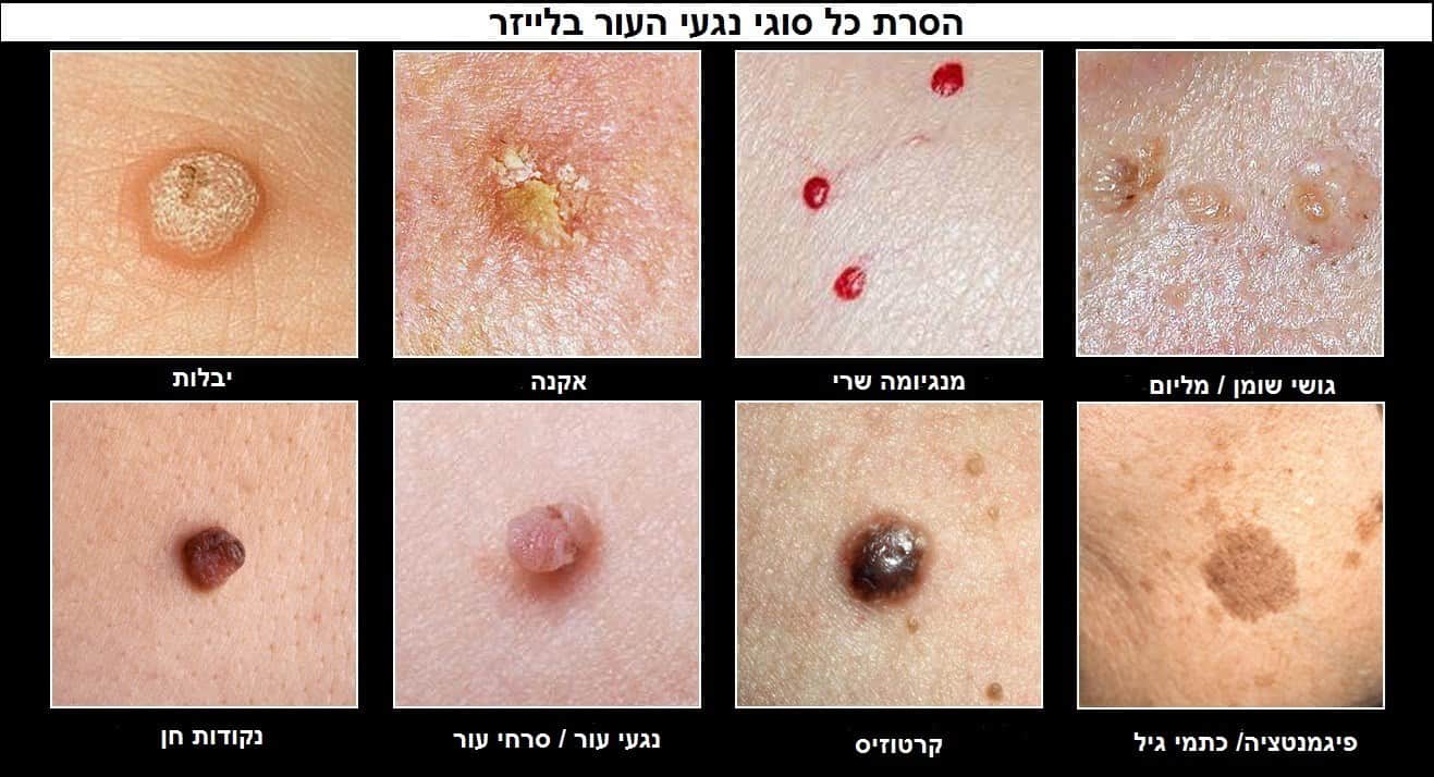 הסרת נגעי עור / סרחי עור בלייזר