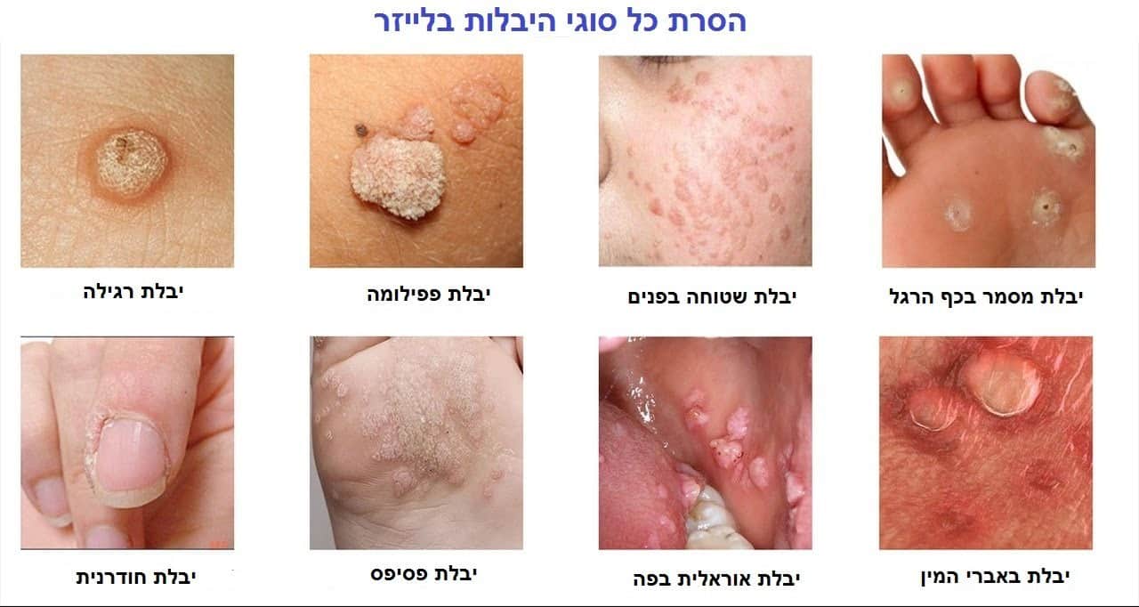 טיפול ביבלות | הסרת יבלות בלייזר